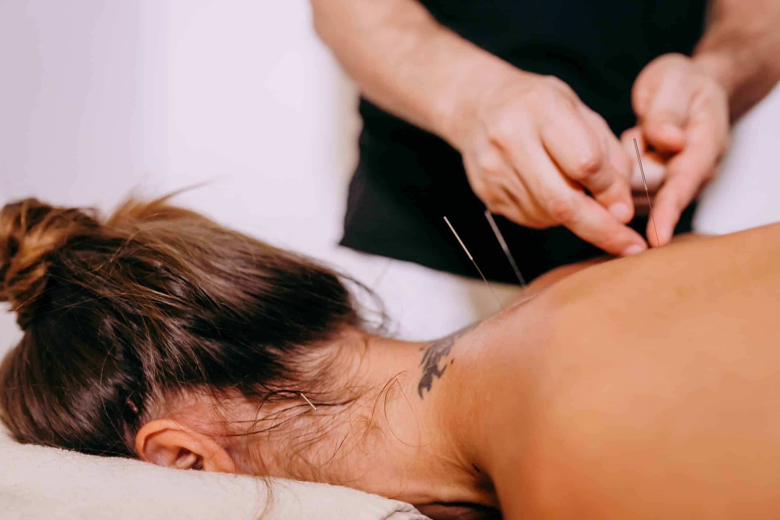 Dry needling TMJ chiropractic for neck and TMJ pain